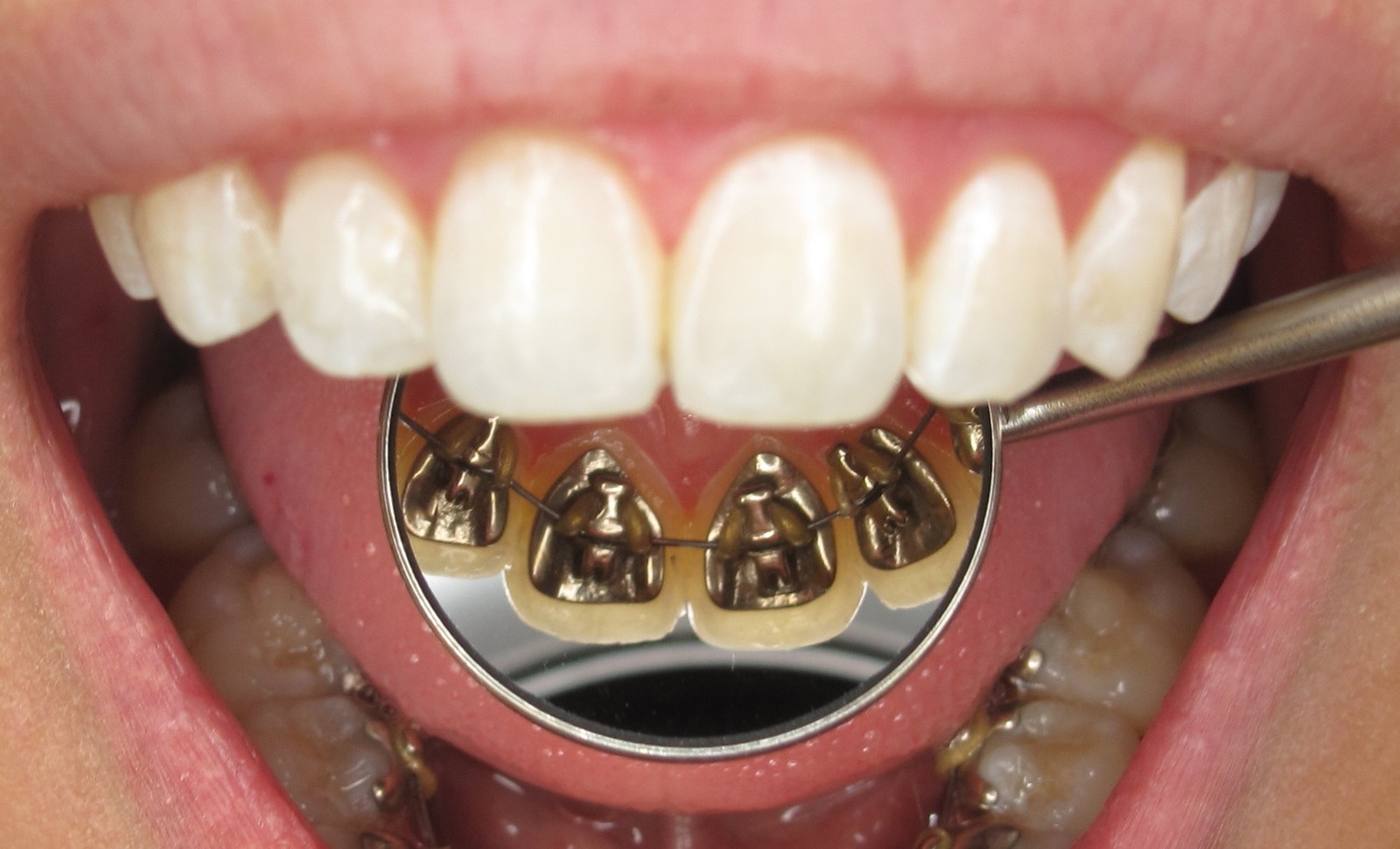 Lingual Braces Stamford, Invisible Braces